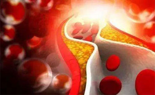 Ѫ֬�ߵ�֢״���� Ѫ֬����ô��